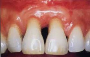 Choroby przyzębia to problem 10 proc. ludzi na całym świecie Europejska Federacja Periodontologiczna walczy z chorobami przyzębia i próchnicą