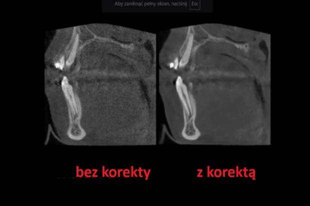 Korekcja obrazu CBCT Problemy z wiarygodnością obrazowania CBCT