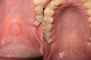Tajemnicze zmiany odkryte przez dentystę Seks oralny doprowadził do zmian w podniebieniu pacjenta