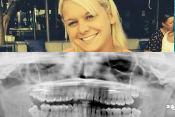 Wpadka dentysty przy ekstrakcji zęba Kobieta oszpecona, bo dentysta poślizgnął się przy ekstrakcji zęba