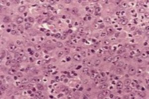 Obraz histologiczny przerzutu raka płaskonabłonkowego do węzła chłonnego (fot. Wikipedia) Stan zapalny zwiększa ryzyko raka jamy ustnej