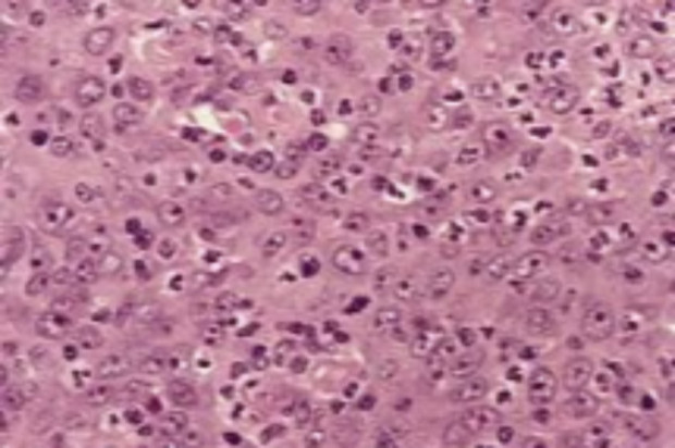 Obraz histologiczny przerzutu raka płaskonabłonkowego do węzła chłonnego (fot. Wikipedia) Stan zapalny zwiększa ryzyko raka jamy ustnej