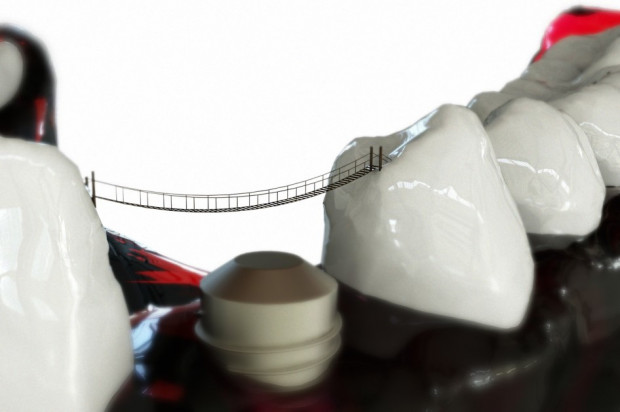 O łącznikach w implantach (foto: pixabay) Implanty częścią kompleksowego leczenia pacjenta