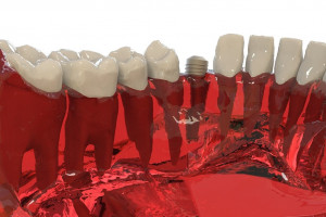 Naukowcy są na tropie materiału, który wyeliminuje niepowodzenia we wszczepianiu implantów (fot. pixabay) Biomateriał na lepsze gojenie kości