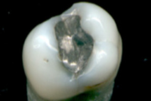 Wypełnienia amalgamatowe odchodzą powoli do lamusa (fot. Wikipedia) Amalgamat na widelcu