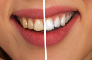 Naukowcy: wybielanie zębów podnosi jakość życia!