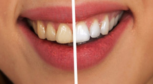 Naukowcy: wybielanie zębów podnosi jakość życia!