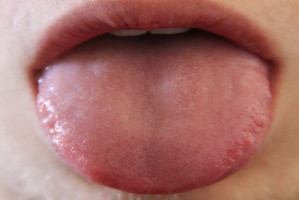 Rak trzustki a bakterie na języku