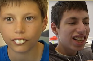 Redukcja „króliczych” zębów