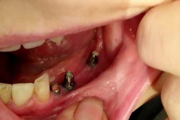 Gisella Gillett prezentuje efekty pracy dentysty 45 tys. funtów za nieudane leczenie implantologiczne