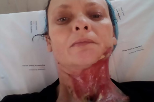 Madelein Carelse w szpitalu Bakterie poczyniły spustoszenie w tkankach miękkich okolicy żuchwy