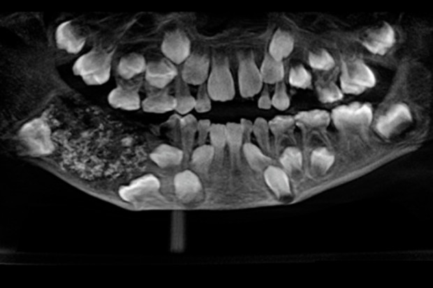 Obraz patologicznych zmian Zębiak złożony zadziwił dentystów z Saveetha Dental College