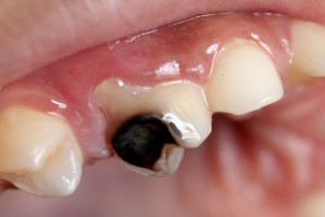 Dzieci chore na cukrzycę typu I są bardziej podatne na próchnicę zębów