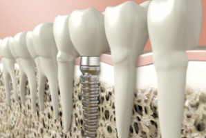 Wybór implantu powinien zależeć od indywidualnych warunków pacjenta (fot. pixabay) Dlaczego implant się nie przyjął?