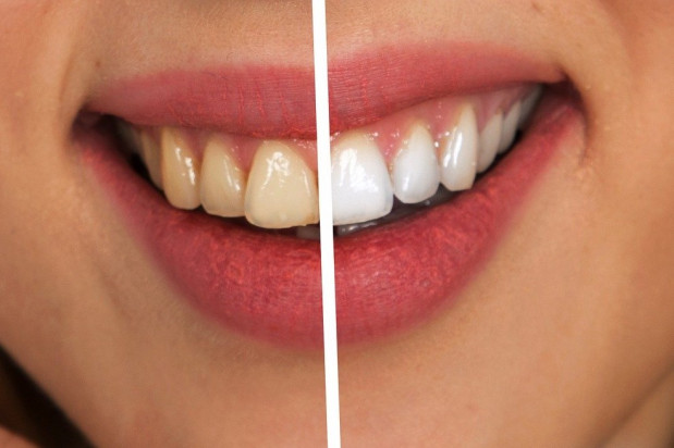 Brak dostępu do opieki stomatologicznej sprawia, że pacjenci sięgają po domowe sposoby wybielania zębów (fot. pixabay) Dentyści walczą o większe nakłady na stomatologię. Sytuacja jest kryzysowa.