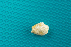 Pacjent z kamieniem gruczołu ślinowego wylądował u dentysty