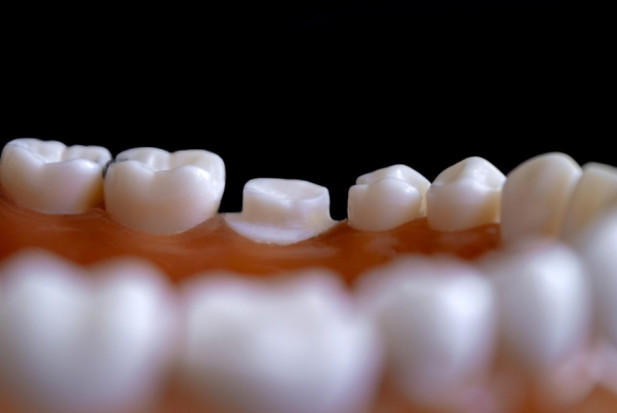 Leczenie zębów zawsze pod pręgierzem zakażenia (foto: pixabay) Pacjent zakażony u dentysty: procedury bezpieczeństwa nie są nowością