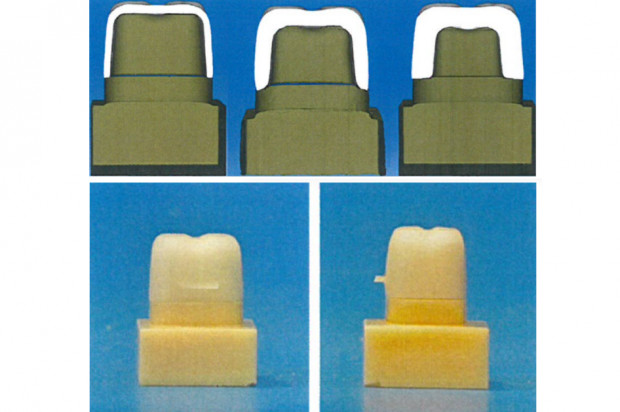 Żywica fotopolimerowa firmy Saremco Dental AG Żywica fotopolimerowa wyzwaniem dla standardowych uzupełnień ceramicznych