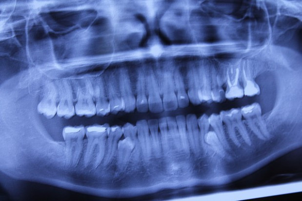 Co dentysta może wyczytać z pantomogramu (fot. pixabay) Stomatolog wykona badanie w kierunku osteoporozy