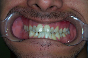 Rezonans u pacjentów ortodontycznych