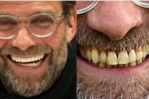 Metamorfoza uśmiechu Jurgena Kloppa Jurgen Klopp: kto stoi za metamorfozą uzębienia niemieckiego trenera