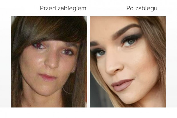 Pacjentka ortognatyczna fot. Medicus Clinic Wady zgryzu - problemem ponad 90 proc. Polaków