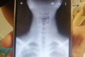 Aparat ortodontyczny utkwił w przełyku (foto: pixaba) Aparat ortodontyczny utknął w przełyku dziecka