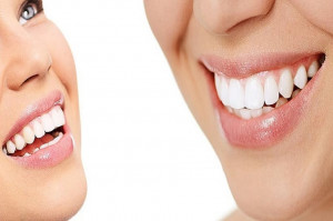 Porcelanowe vs kompozytowe licówki (fot. pixabay) Trwałość licówek przebadana