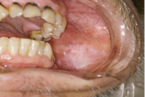 Rak jamy ustnej diagnozowany rzadziej o 30 proc.