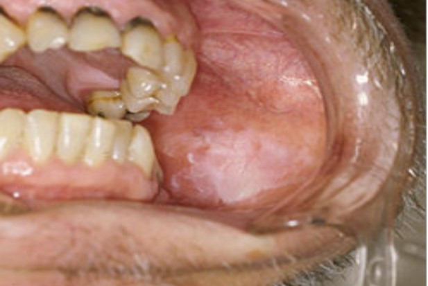 Rak jamy ustnej diagnozowany rzadziej o 30 proc.