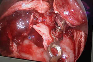 Zdjęcie endoskopu w trakcie osteosyntezy (fot. GUMed) GUMed: zabieg osteosyntezy złamania wyrostka kłykciowego żuchwy