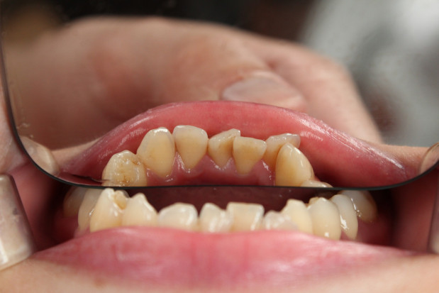 Dentysta wynalazcą sposobu na kserostomię
