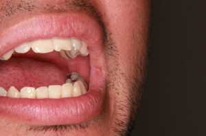 Silny związek powiększenia ślinianek i kserostomii z ciężkim przebiegiem COVID-19 (fot. Shutterstock) Ozdrowieńcy: problemy ze zdrowiem jamy ustnej