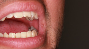 Ozdrowieńcy: problemy ze zdrowiem jamy ustnej