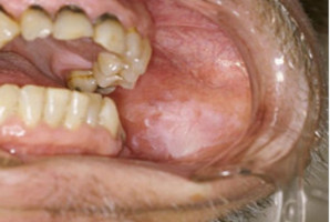 Leukoplakia (fot. Wikipedia) O raku jamy ustnej mówi się w kwietniu