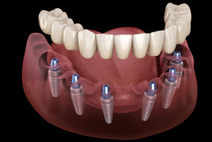 Usprawnienie regeneracji kości szczękowej po usunięciu zęba (fot. shutterstock) Stomatologia: membrana usprawniająca regenerację kości