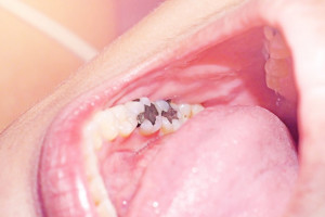 FDA wobec amalgamatu stomatologicznego (fot. shutterstock) FDA o wypełnieniach amalgamatowych