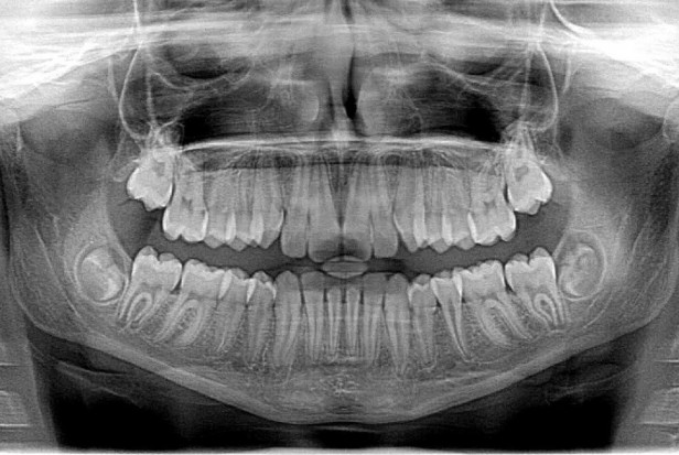 Aplikacja pomagająca interpretować zdjęcia rentgenowskie w stomatologii