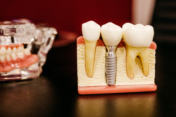 Osoby z niską higieną jamy ustnej są bardziej narażone na utratę implantu (fot. Unsplash) Implanty zębowe a ryzyko powikłań