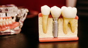 Implanty zębowe a  ryzyko powikłań