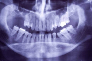 Drastyczne problemy z leczeniem implantoprotetycznym (fot. archwium) Gdy na leczeniu grube pieniądze tracą dentysta i jego pacjent