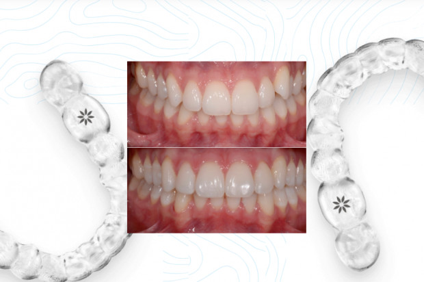 Invisalign: o tym każdy ortodonta powinien wiedzieć