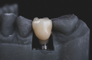 Osteoporoza może spowodować utratę implantu zębowego (fot. Unsplash) Bezpieczeństwo implantów u chorych na osteoporozę