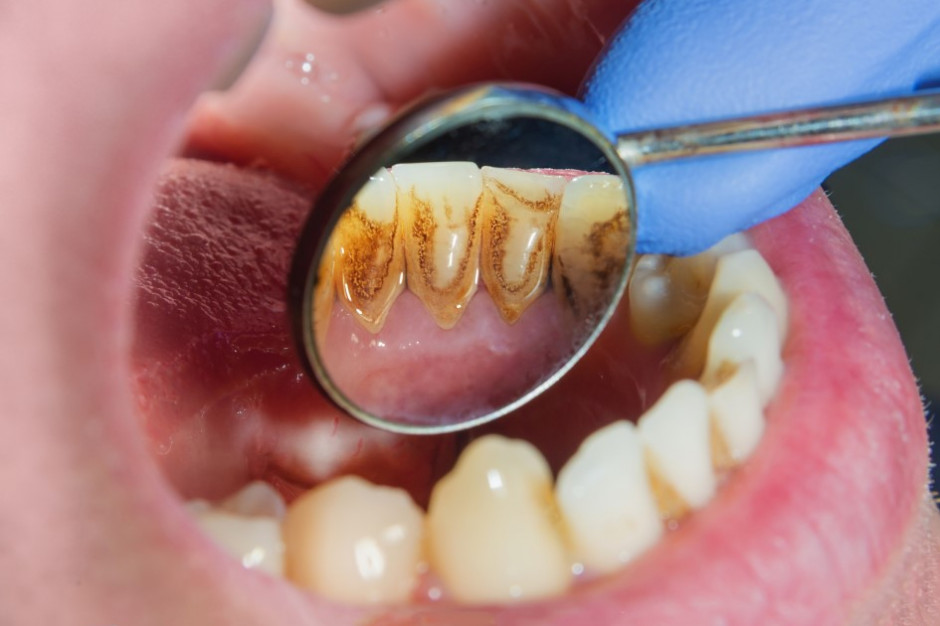 Płytka nazębna nie jest jedyną pandemią pacjentów stomatologicznych (fot. shutterstock)