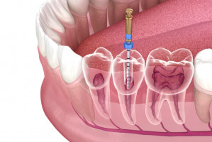 Na kursie tajemnice mechanicznego opracowania kanałów (fot. Shutterstock) DIL organizuje bezpłatny kurs z endodoncji