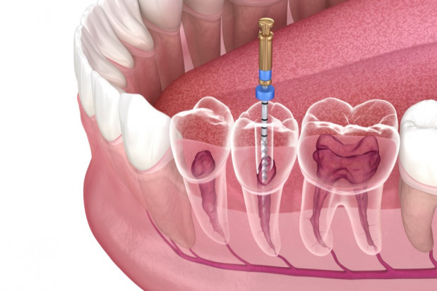Na kursie tajemnice mechanicznego opracowania kanałów (fot. Shutterstock) DIL organizuje bezpłatny kurs z endodoncji