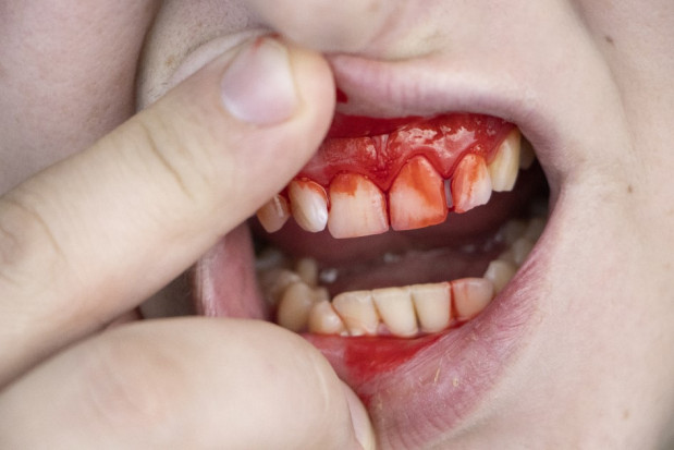 Uraz zęba: jakie leczenie i kiedy