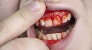 Uraz zęba: jakie leczenie i kiedy