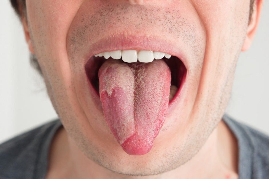 O język trzeba dbać jak o zęby (fot. shutterstock) O język trzeba dbać jak o zęby (fot. shutterstock)