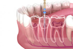 Leczenie endodontyczne w mitach (fot. shutterstock) Leczenie kanałowe - co jest mitem?